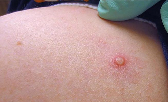 OMS reporta más de 3 mil casos de viruela del mono; sumaron mil en una semana