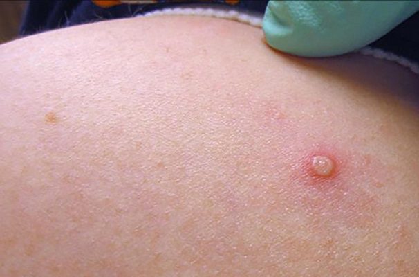 Casos de viruela del mono aumentan a tres mil en 10 días: OMS