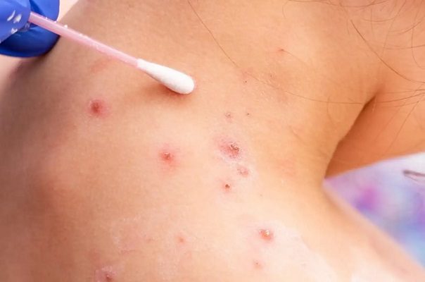 Se han duplicado los casos de viruela del mono en México: OMS