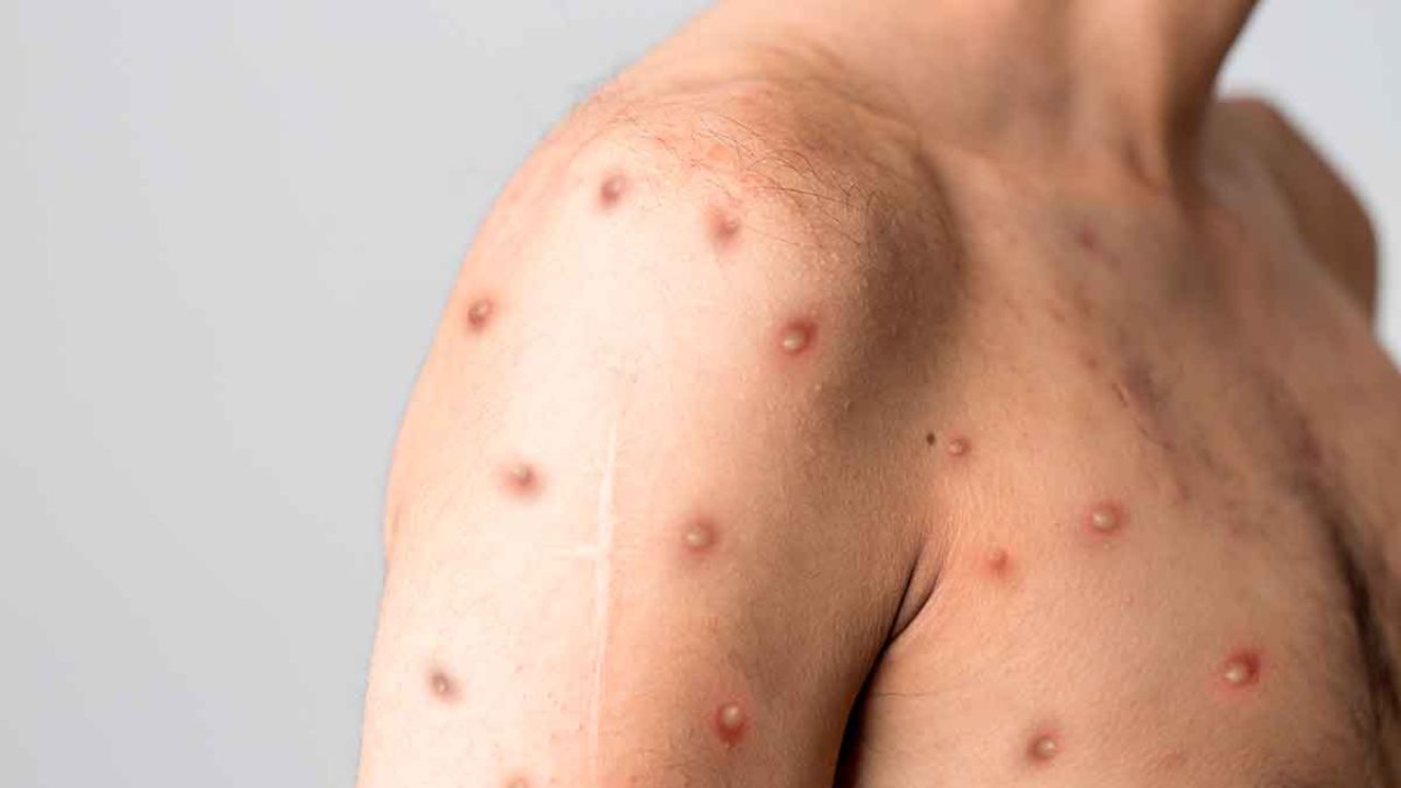 Cinco casos confirmados de viruela del mono en Jalisco