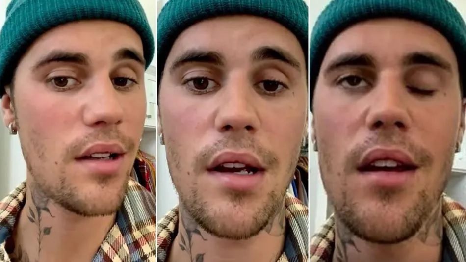 Justin Bieber informa que tiene parálisis facial