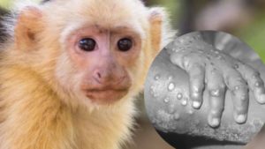 Chile reporta su primer caso confirmado de viruela del mono