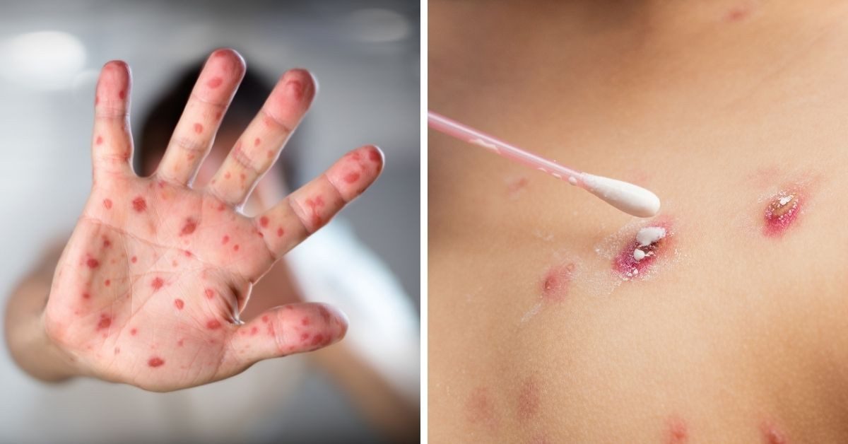 Viruela del mono en Canadá