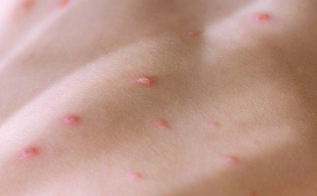 Se registran más de 5 mil casos de viruela del mono a nivel mundial: OMS