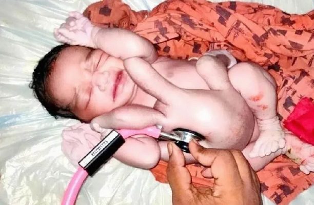 Nace bebé en India con cuatro brazos y piernas; aseguran es "reencarnación de Dios"