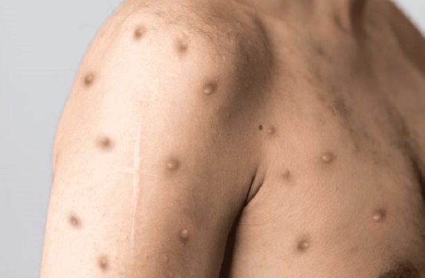 Confirman dos casos de viruela símica en Edomex mientras OMS llama a reunión de emergencia