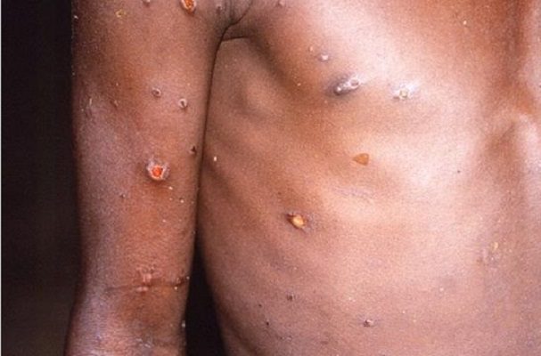 Casos de viruela del mono aumentaron 77% en en una semana, alerta la OMS