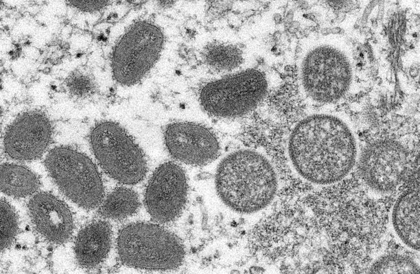 Se detecta el primer caso de viruela del mono en Nuevo León