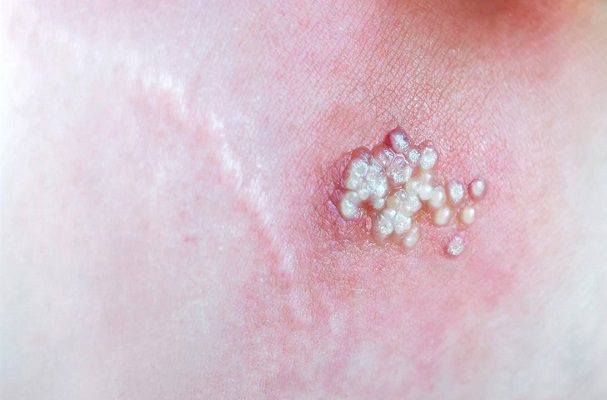 Francia recomienda a homosexuales y trabajadores sexuales vacunarse contra viruela mono