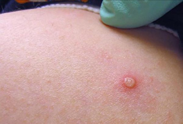 Suman 9,200 casos de viruela del mono en todo el mundo, reporta OMS