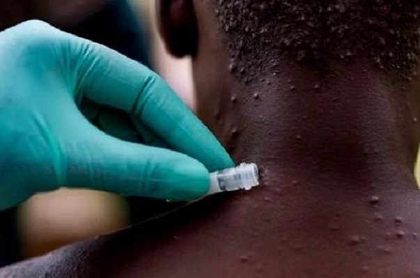 La OPS reporta 35 casos de viruela del mono en seis estado de México