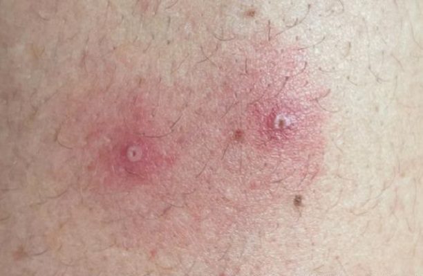 UE compra más de 54 mil vacunas contra viruela del mono ante alza de casos