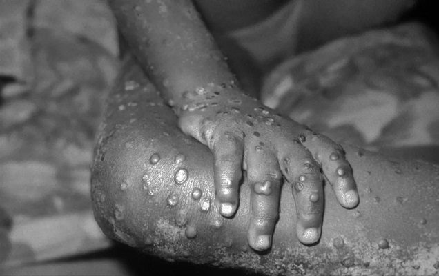 Sinaloa establece controles sanitarios en aeropuertos y centrales de autobús por viruela del mono