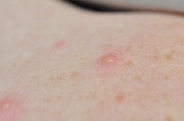 Confirman 2 casos más de viruela de mono en Nuevo León