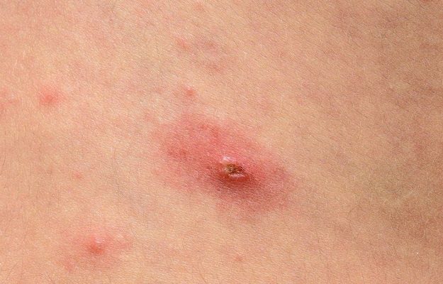 Se registran 48 casos de viruela del mono en México, reporta la OPS