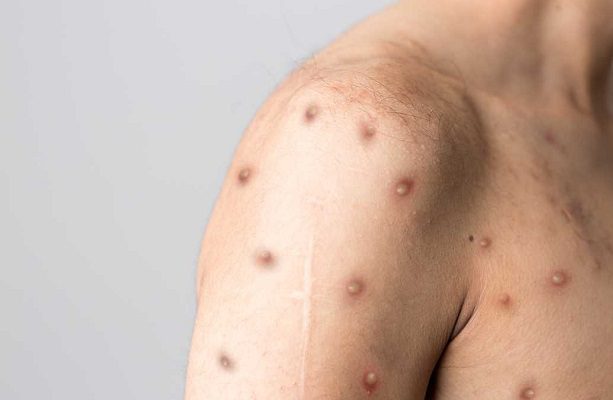 Los casos de viruela del mono en el mundo ascienden a 14 mil: OMS