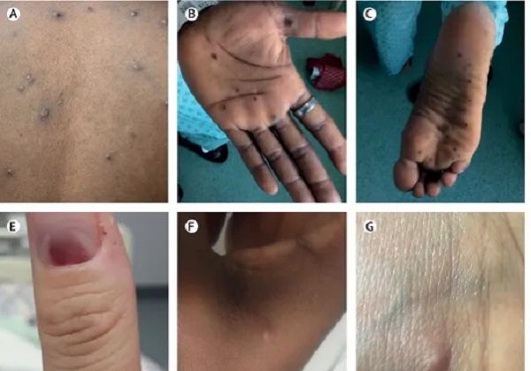 OMS analiza si la viruela del mono puede ser una emergencia mundial