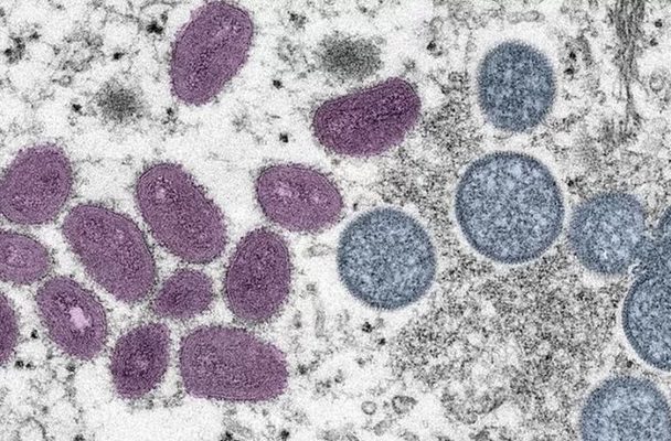 Un bebé de siete meses da positivo a viruela del mono en Madrid