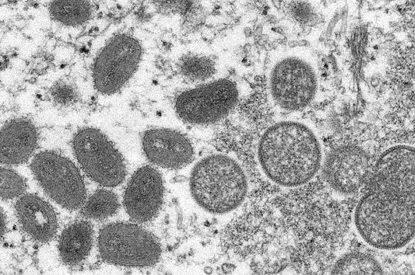Japón detecta su primer caso de viruela del mono