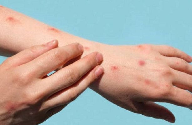 Se confirma el primer caso de viruela del mono en Oaxaca