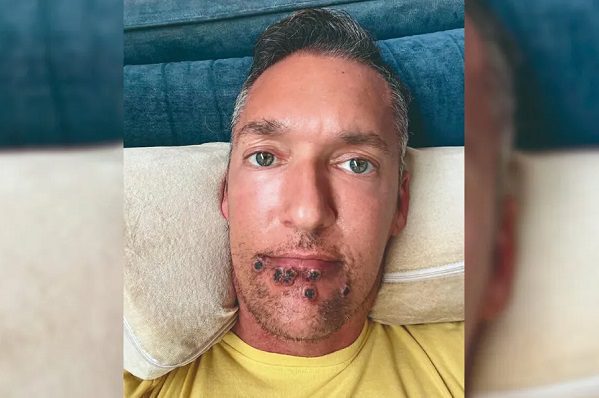 Actor porno cuenta su experiencia tras contraer viruela del mono