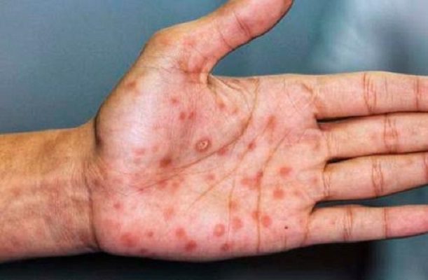 Vacuna contra viruela del mono tarda semanas en inmunizar: OMS