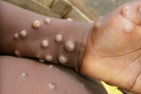 La OMS asegura que no es necesaria la vacunación masiva contra la viruela del mono