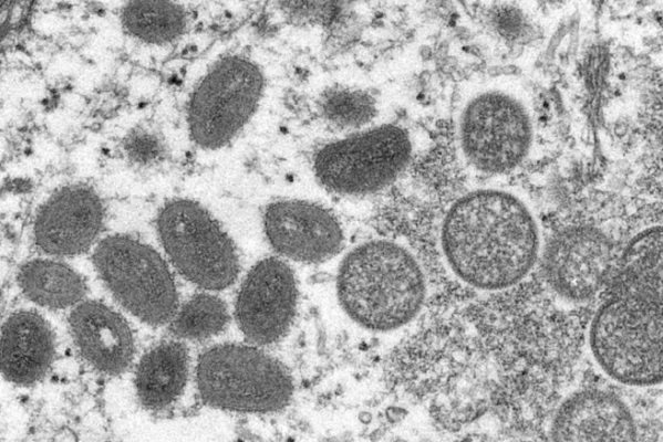 En menos de 24 horas, se confirma un segundo caso de viruela del mono en Oaxaca