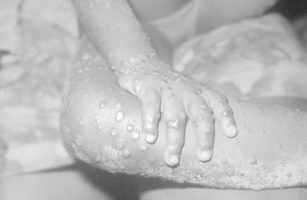 La OMS pide reducir el número de parejas sexuales ante el brote de viruela del mono