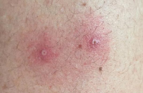 Estados Unidos reporta 1,048 casos nuevos de viruela del mono en un día