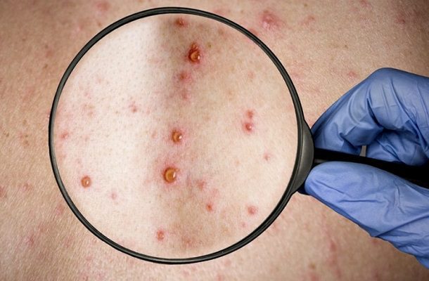 Brasil confirma su primera muerte por viruela del mono