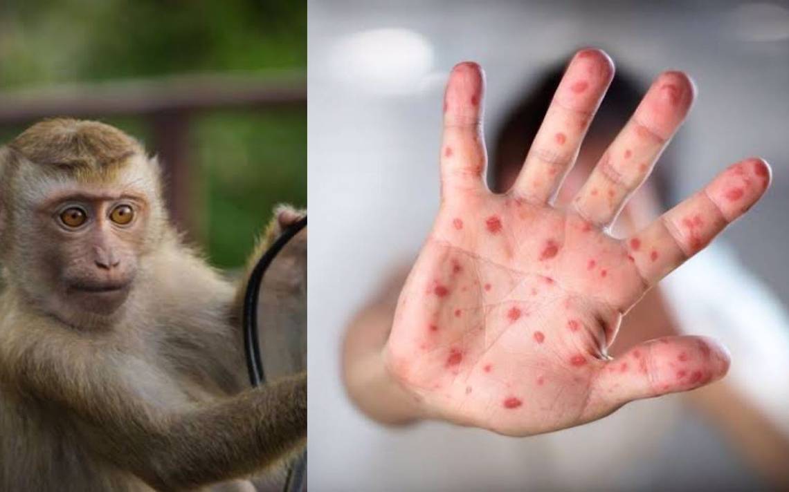 México suma 60 casos de viruela del mono
