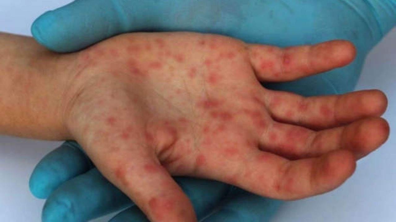 Viruela del mono en la CDMX