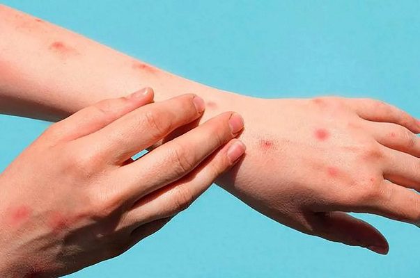 Se detectan los primeros casos de viruela del mono en Michoacán y BCS