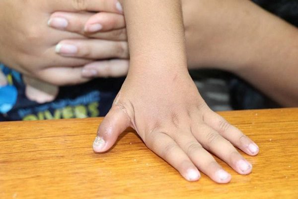 Cirujanos del IMSS en NL reimplantan pulgar a niño de dos años