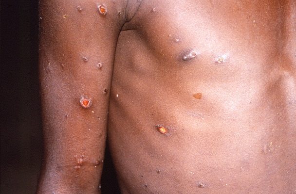 Uno más. Perú notifica su primera muerte vinculada con la viruela del mono