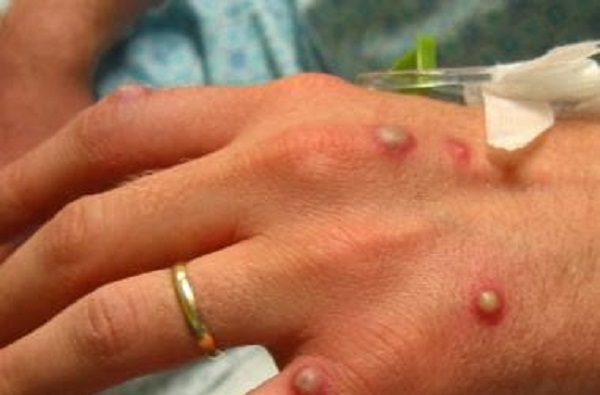 El gobierno de EE.UU. declara la viruela del mono como una emergencia de salud pública