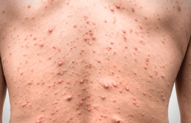 Nuevo León suma tres casos positivos de viruela del mono