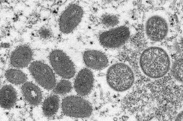 Alertan infecciones de variante distinta de viruela del mono en la India