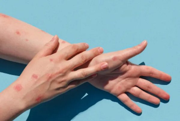 Casos de viruela del mono bajan 6% a nivel mundial, informa OMS