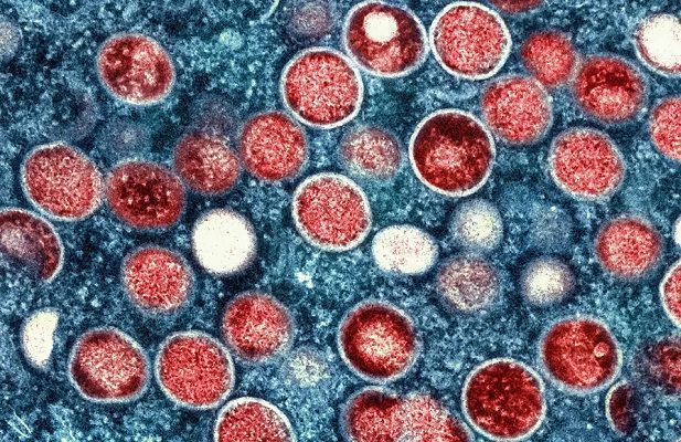 San Luis Potosí confirma su primer caso de viruela del mono