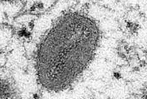 Se detecta el primer caso de viruela del mono en Guanajuato