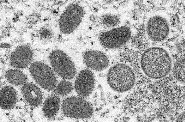 Suman 252 casos de viruela del mono en México
