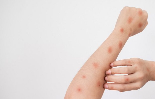 Irán reporta su primer caso de viruela del mono