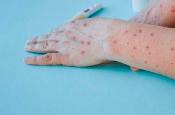 OMS pide calma ante primer caso de transmisión de viruela del mono a perro