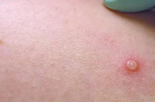 Sonora confirma sus primeros dos casos de viruela del mono