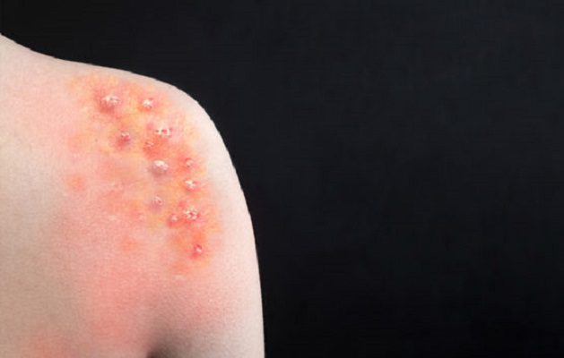 'Gripe del tomate', nuevo virus que afecta a niños menores de 5 años