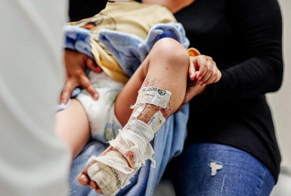 Injertan piel cultivada para atender quemaduras en nuevo tratamiento del IMSS