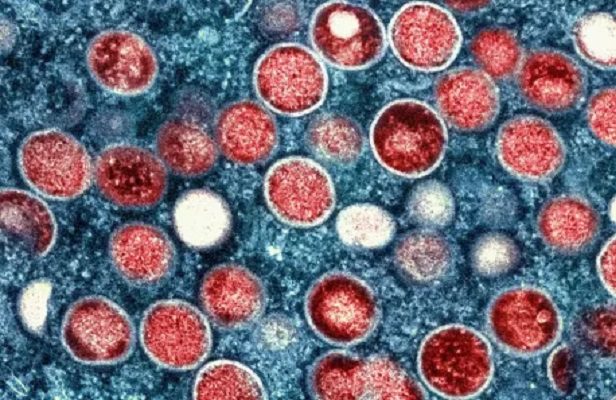 UNAM lanza guía para actuar frente a casos sospechosos de viruela del mono