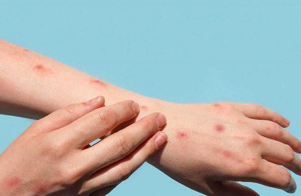 Aumentan a 386 los casos confirmados de viruela del mono en México